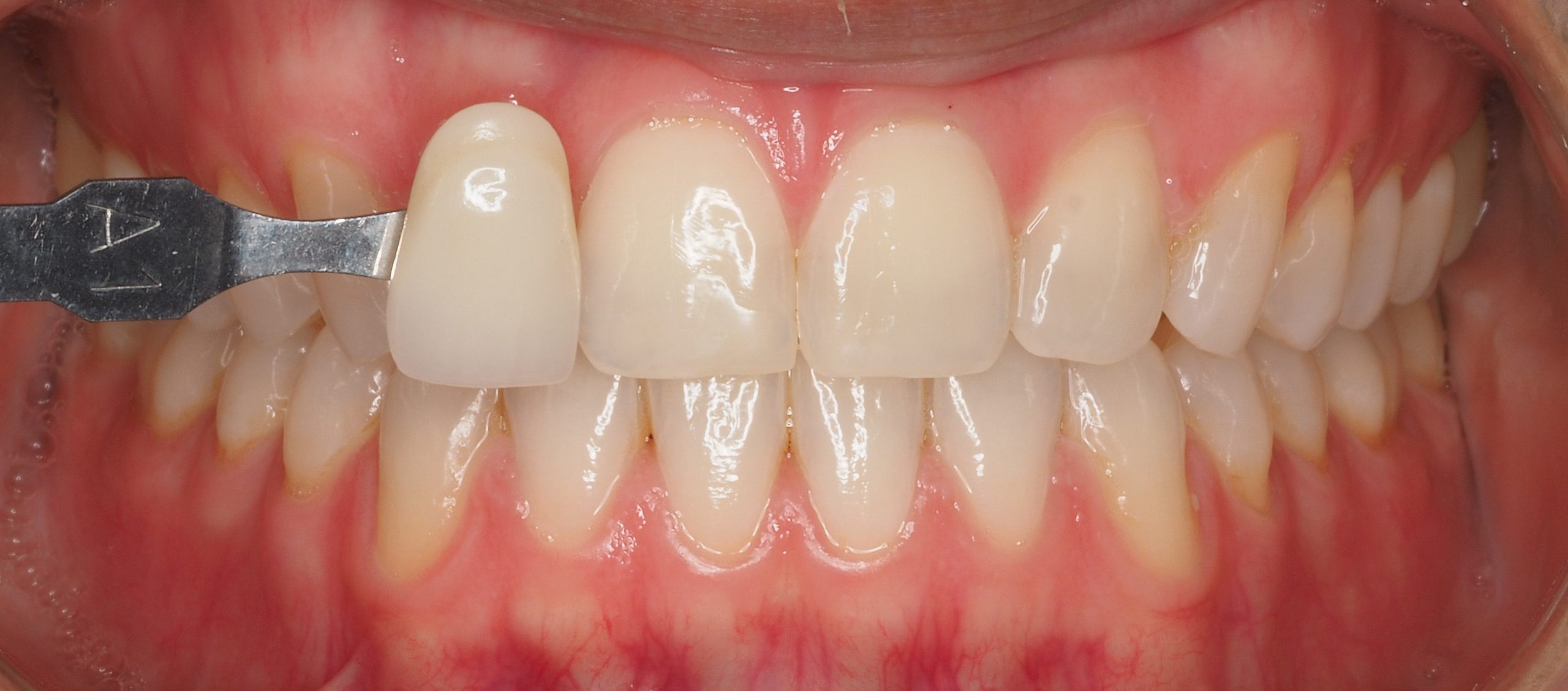 DESPRES CAS 3 blanquejament